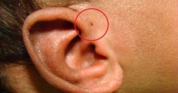 Have You Seen Someone With A ‘Tiny Hole’ Above Their Ears? This Is What It Means
