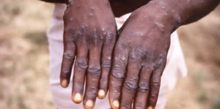Kenya  Increases Watch On Monkeypox
