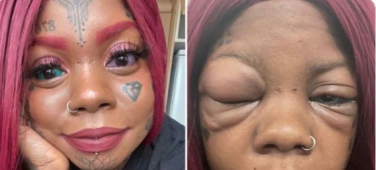 Woman Goes Blind After Tattooing Her Eyeball